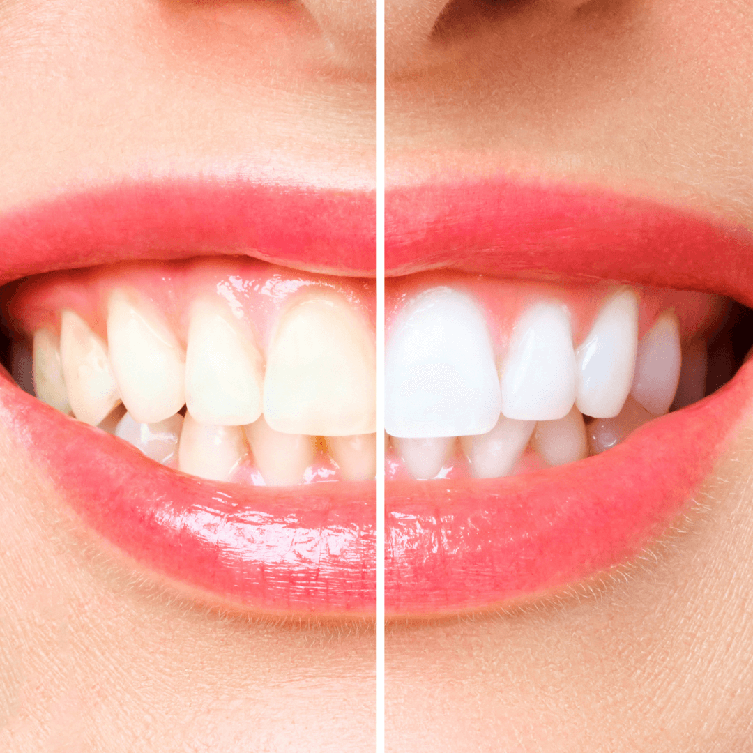 Tẩy Trắng Răng Tại Nha Khoa Thiện Phước